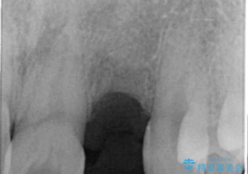 前歯部 インプラント治療の治療前