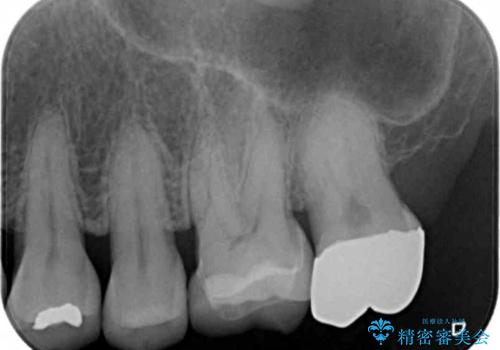 割れた被せ物を作りなおしたいの治療前