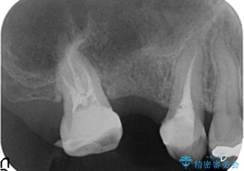 「 セラミック治療 」奥歯を白くしたいの治療前