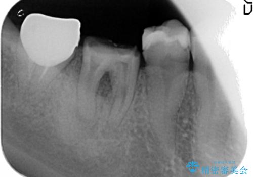 銀歯の下に大きな虫歯の再発の治療前