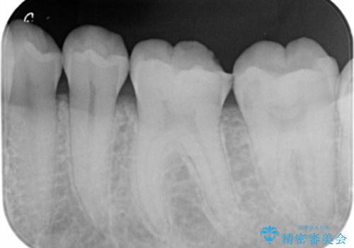 詰め物が欠けてしみるの治療前