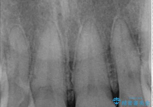 転んで欠けてしまった前歯 抜歯を回避してオールセラミッククラウンで審美回復の治療前