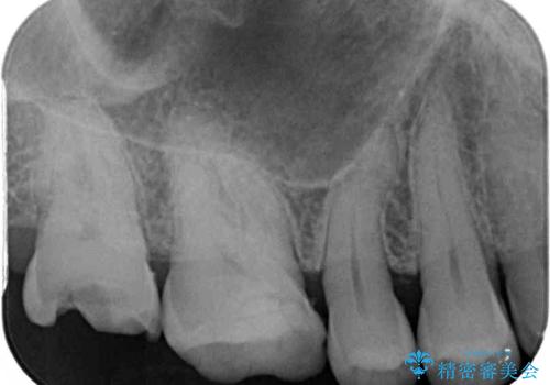 虫歯で銀歯が外れた　ゴールドインレーによる虫歯治療の治療前