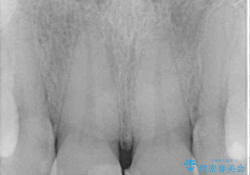 つぎはぎだらけの前歯 オールセラミッククラウンで自然な歯にの治療前