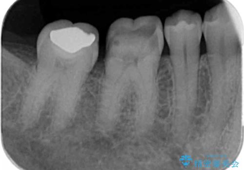 銀歯が取れた セラミックでのやり替えの治療前