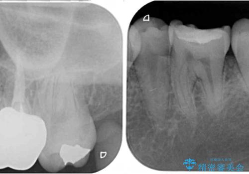 【モニター】隠れている下顎の前歯をインビザラインで改善の治療前