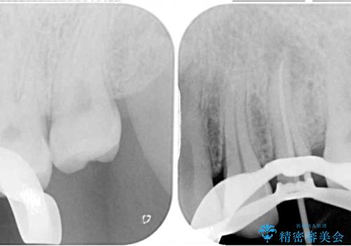 上下の歯が接触するだけで痛い 根管治療とオールセラミック治療の治療中