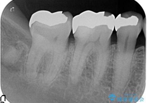 口を開けると銀歯が見えるのが嫌だ。の治療前