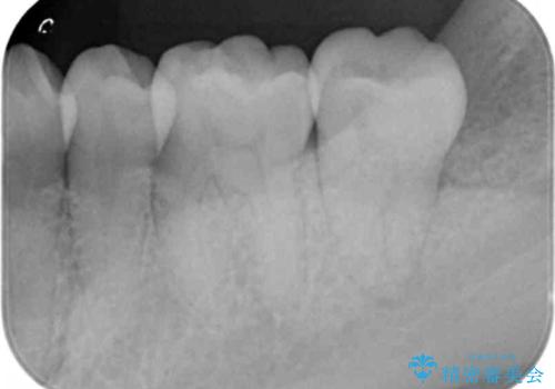 奥歯の詰め物をやり替えたい　セラミックインレーでの治療の治療前