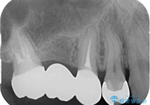 「 セラミック治療 」奥歯を白くしたいの治療後