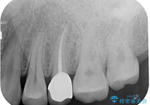 上下の歯が接触するだけで痛い 根管治療とオールセラミック治療の治療後