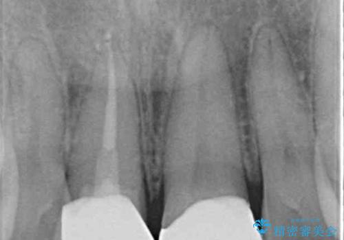 転んで欠けてしまった前歯 抜歯を回避してオールセラミッククラウンで審美回復の治療後