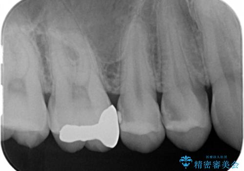 虫歯治療の治療前