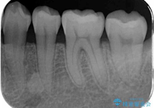 奥歯の詰め物をやり替えたい　セラミックインレーでの治療の治療後