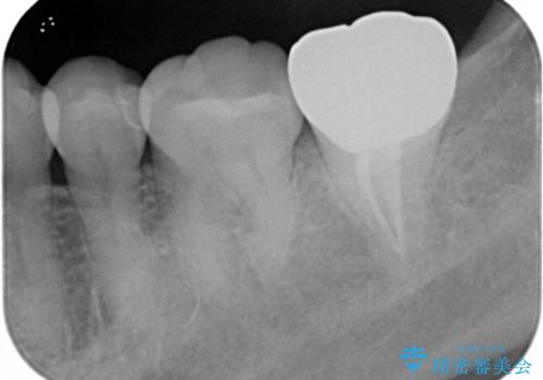 歯の噛む面が黒い。の治療前