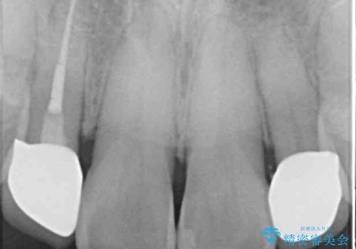 左右に骨格がずれて咬みにくい ワイヤー装置による抜歯矯正の治療後