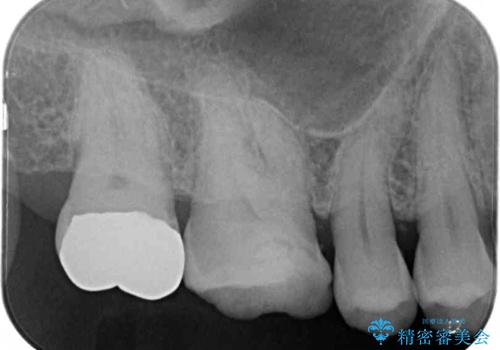 虫歯で銀歯が外れた　ゴールドインレーによる虫歯治療の治療後