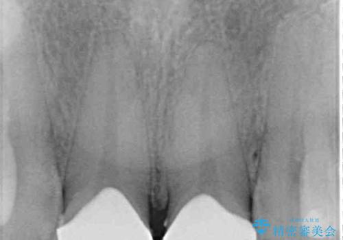 つぎはぎだらけの前歯 オールセラミッククラウンで自然な歯にの治療後