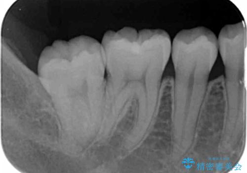 奥歯の深い黒ずみ　セラミックインレーでの治療の治療前