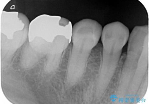 口を開けると銀歯が見えるのが嫌だ。の治療後