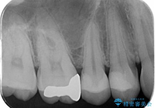 虫歯治療の治療後