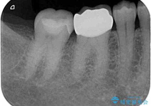 銀歯が取れた セラミックでのやり替えの治療後