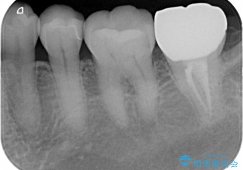歯の噛む面が黒い。の治療後