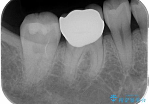 ジルコニアクラウンの治療後