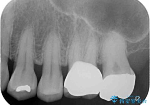 割れた被せ物を作りなおしたいの治療後