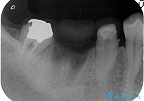 銀歯の下に大きな虫歯の再発の治療中