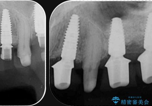 [ 重度歯周病 ] 骨造成・インプラント治療による咬合機能の回復の治療中