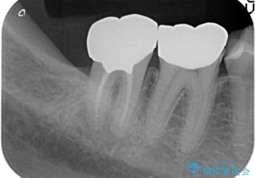 「 セラミック治療 」奥歯を白くしたいの治療前