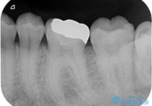 詰め物が欠けてしみるの治療後