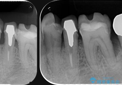 [ 重度歯周病 ] 骨造成・インプラント治療による咬合機能の回復の治療前