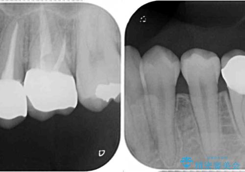 【モニター】隠れている下顎の前歯をインビザラインで改善の治療後