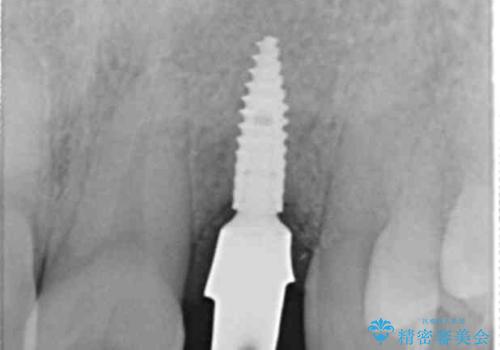前歯部 インプラント治療の治療中