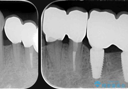 [ 重度歯周病 ] 骨造成・インプラント治療による咬合機能の回復の治療後