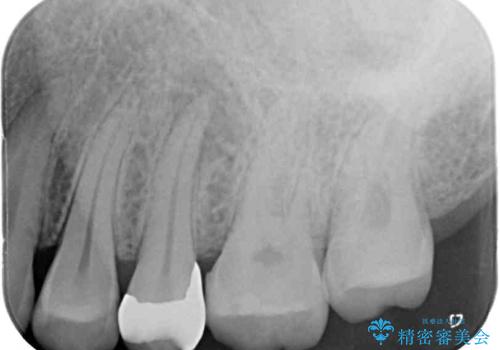 上下の歯が接触するだけで痛い 根管治療とオールセラミック治療の治療前