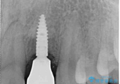 前歯部 インプラント治療の治療後