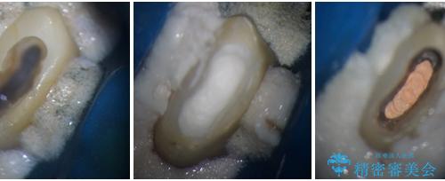 上下の歯が接触するだけで痛い 根管治療とオールセラミック治療の治療中