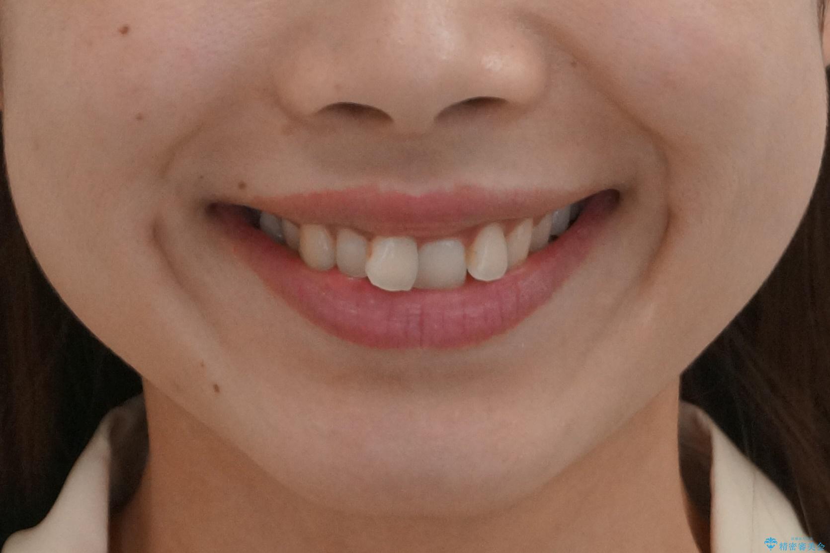 マウスピース矯正では難しい治療にも対応します 歯を抜かない矯正の治療前(顔貌)