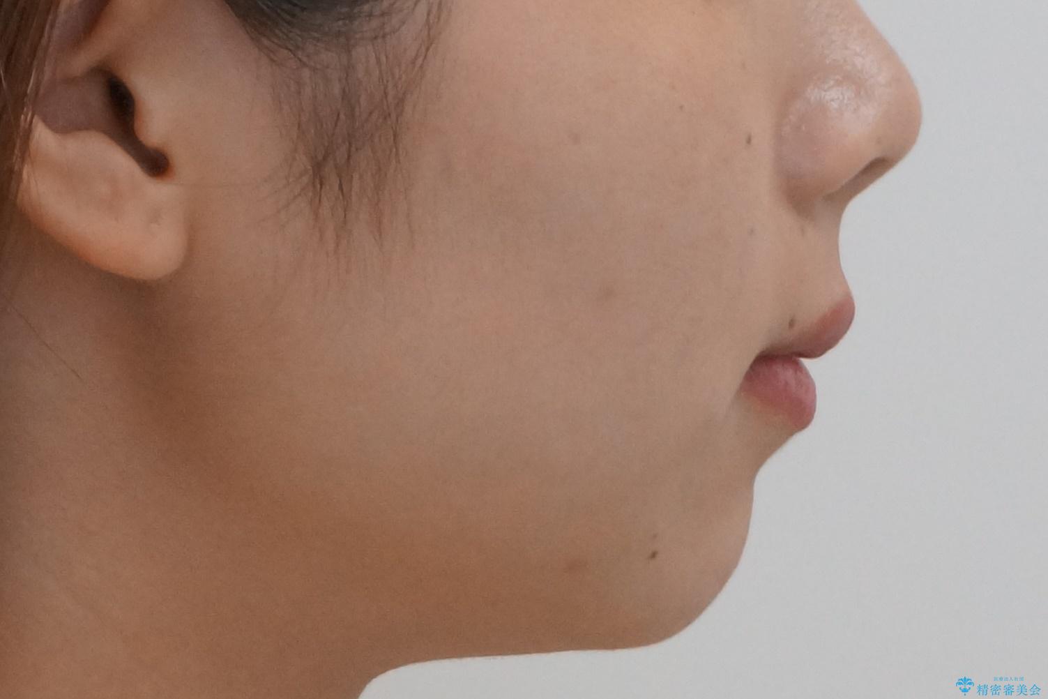 マウスピース矯正では難しい治療にも対応します 歯を抜かない矯正の治療前(顔貌)