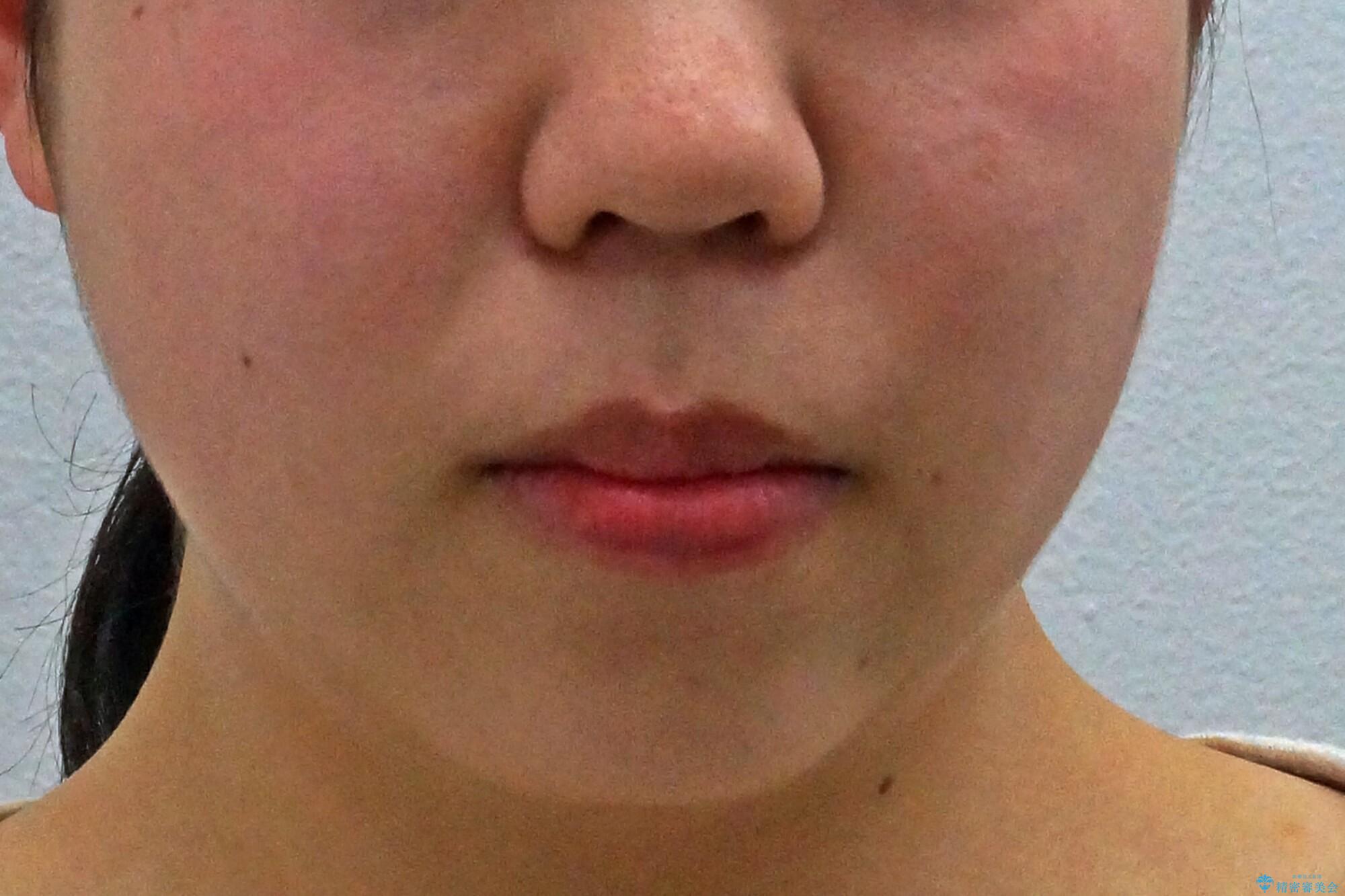 かみ合わせが悪いところを ワイヤー矯正でしっかり治療 マウスピース矯正は難しい症例の治療前(顔貌)