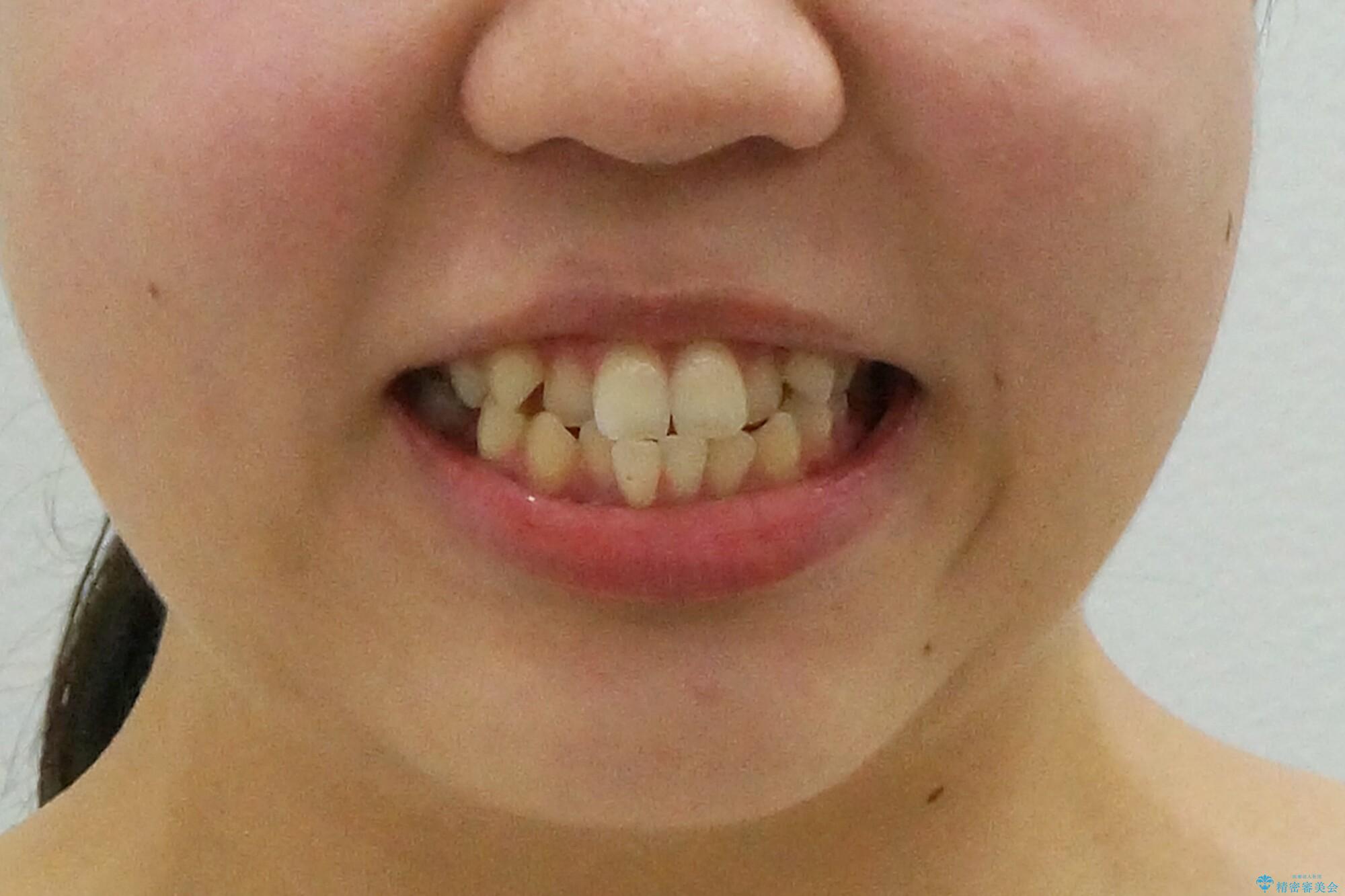 かみ合わせが悪いところを ワイヤー矯正でしっかり治療 マウスピース矯正は難しい症例の治療前(顔貌)