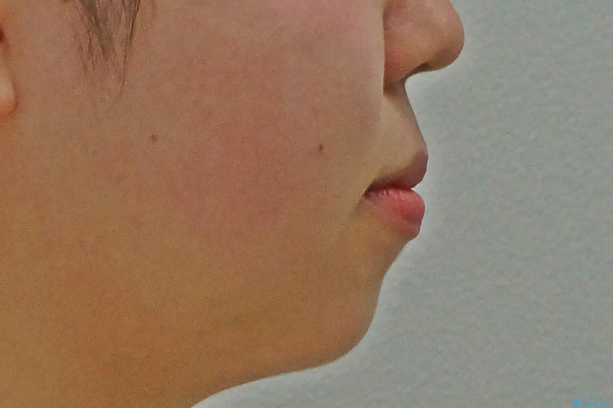 かみ合わせが悪いところを ワイヤー矯正でしっかり治療 マウスピース矯正は難しい症例の治療前(顔貌)