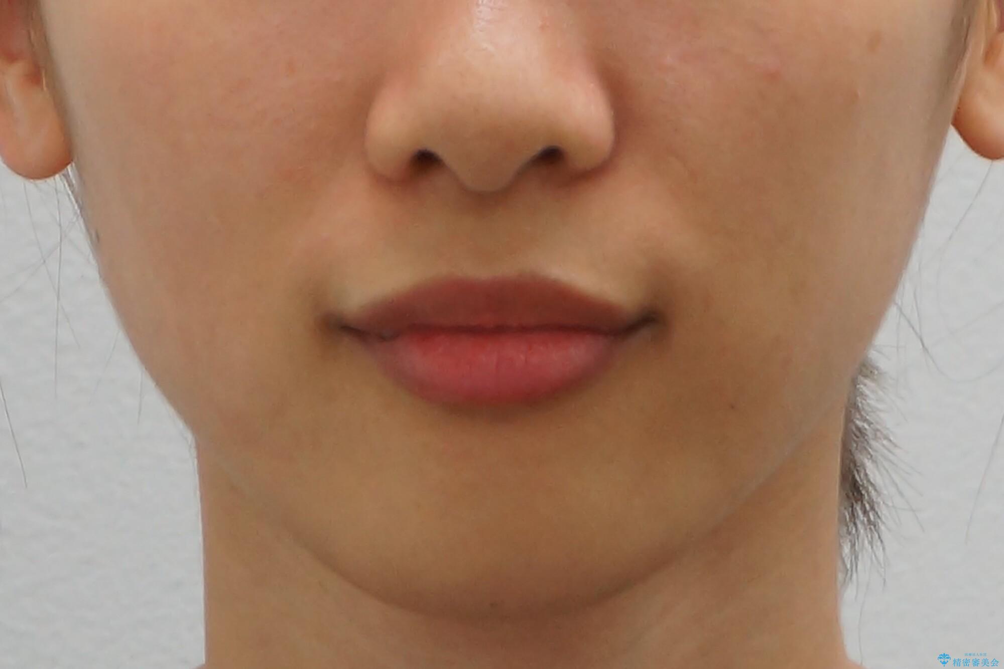 親知らずを生かした矯正の治療前(顔貌)