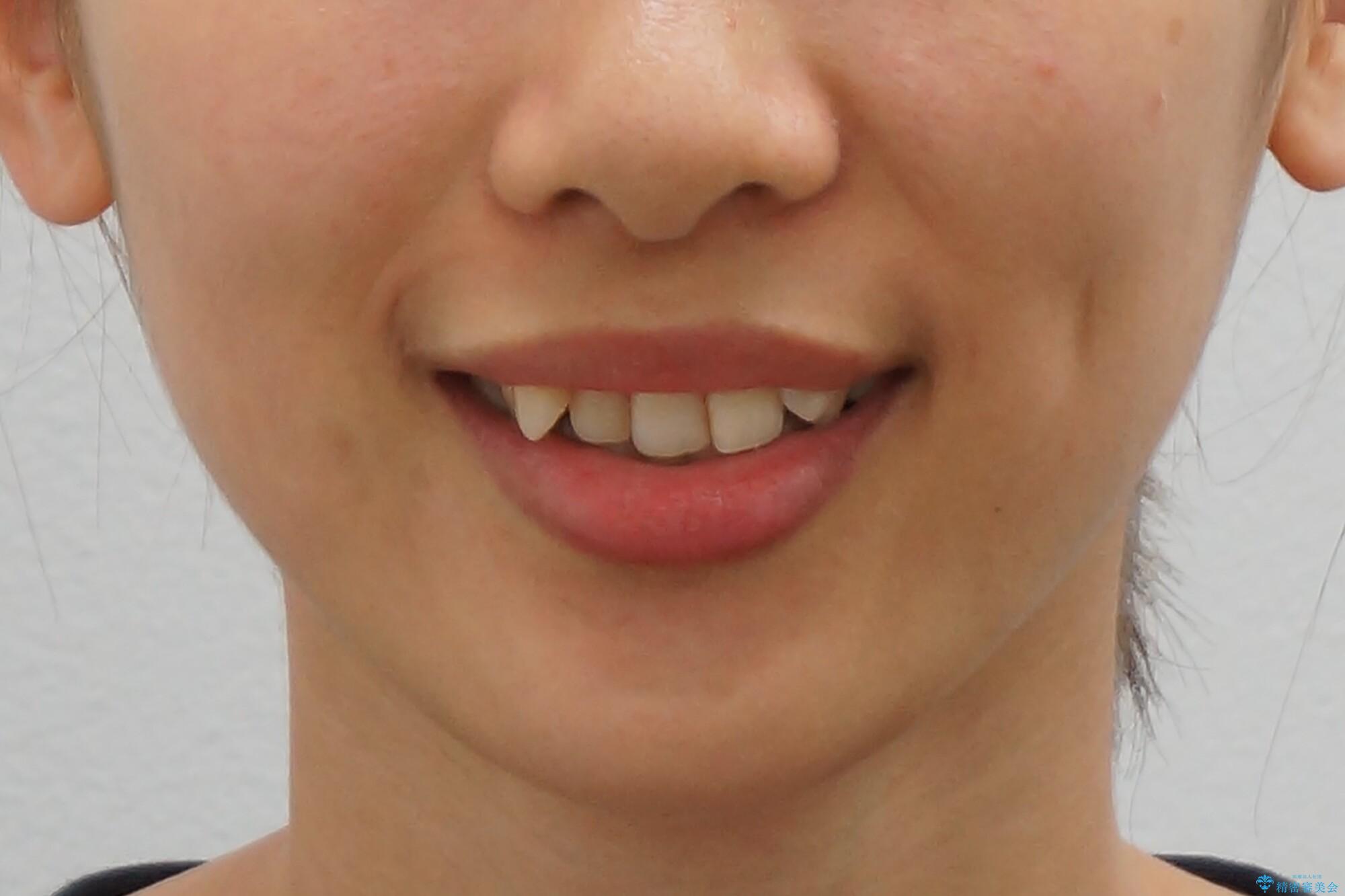 親知らずを生かした矯正の治療前(顔貌)