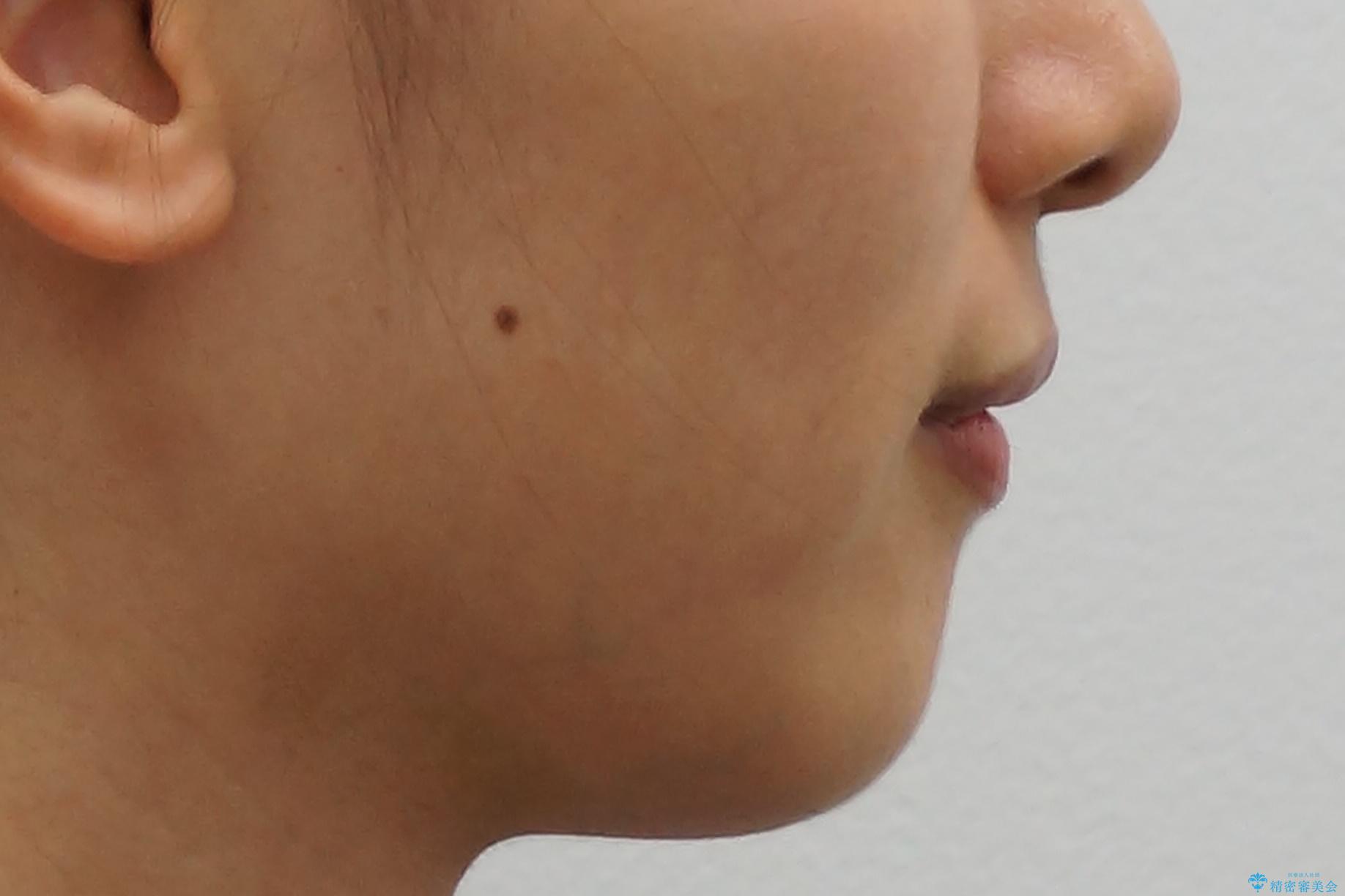 親知らずを生かした矯正の治療前(顔貌)