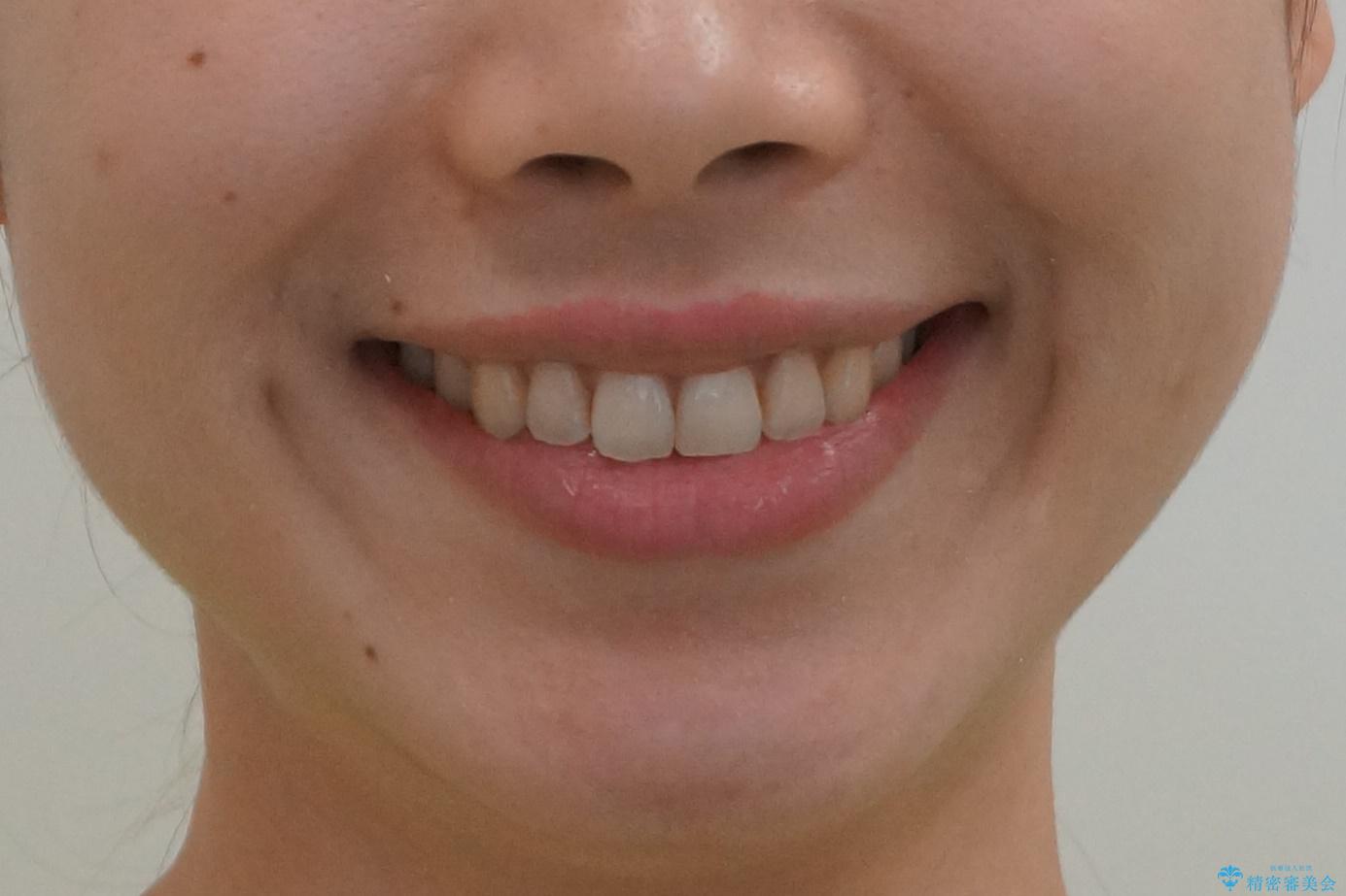マウスピース矯正では難しい治療にも対応します 歯を抜かない矯正の治療後(顔貌)