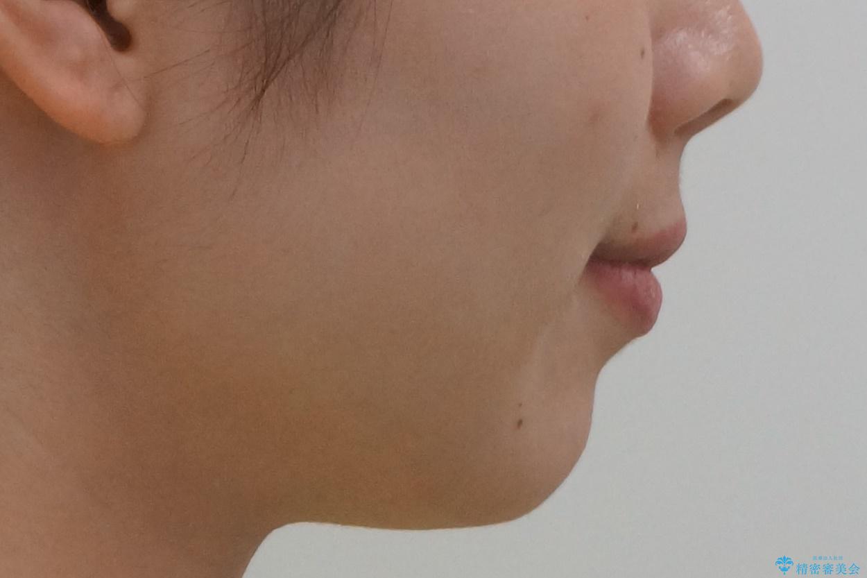 マウスピース矯正では難しい治療にも対応します 歯を抜かない矯正の治療後(顔貌)